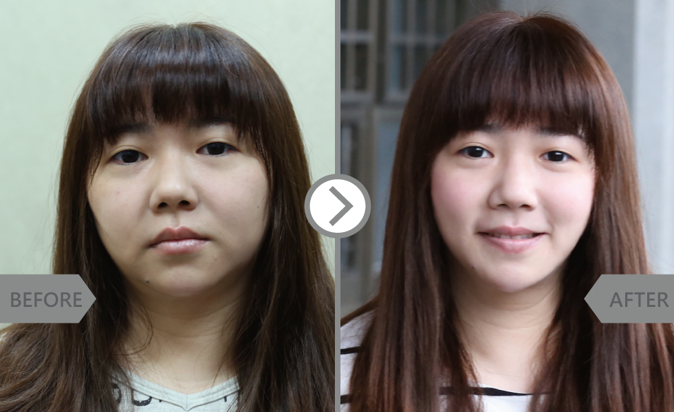 直接上圖,有做有差呢!斑點、鬆弛問題整個改善,原本的短下巴拉長,讓臉型比例變好看。