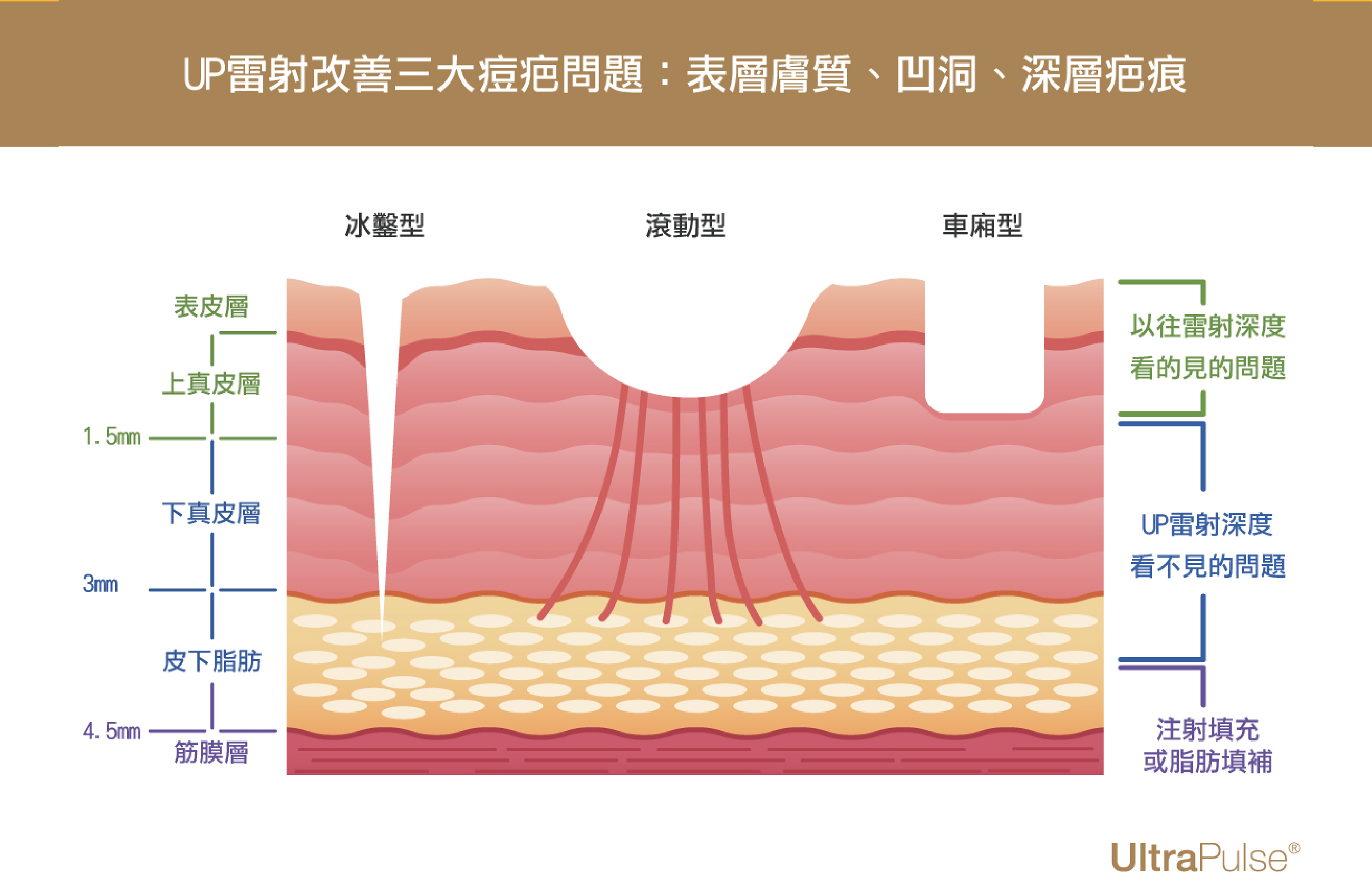 什麼是UP雷射？