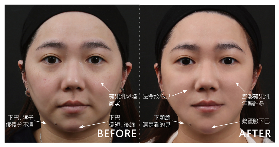 人老了、膠原蛋白流失就容易鬆弛,看看我的脖子跟下巴都要連成一線了。透過除皺瘦臉針治療後,輪廓線變清楚了;玻尿酸填補在下巴,讓臉型拉長,從圓臉變成鵝蛋臉,另外,再利用玻尿酸進行中頰拉提,蘋果肌重新長出來了、法令紋就此說Bye;4D皮秒雷射幫我改善斑點、色素的問題。