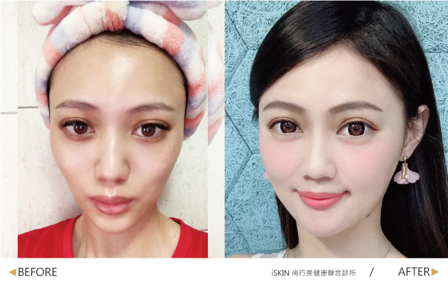 在iSKIN盧靜怡醫療團隊下,利用玻尿酸讓我重新找回美麗泉源,苦命臉拜拜
