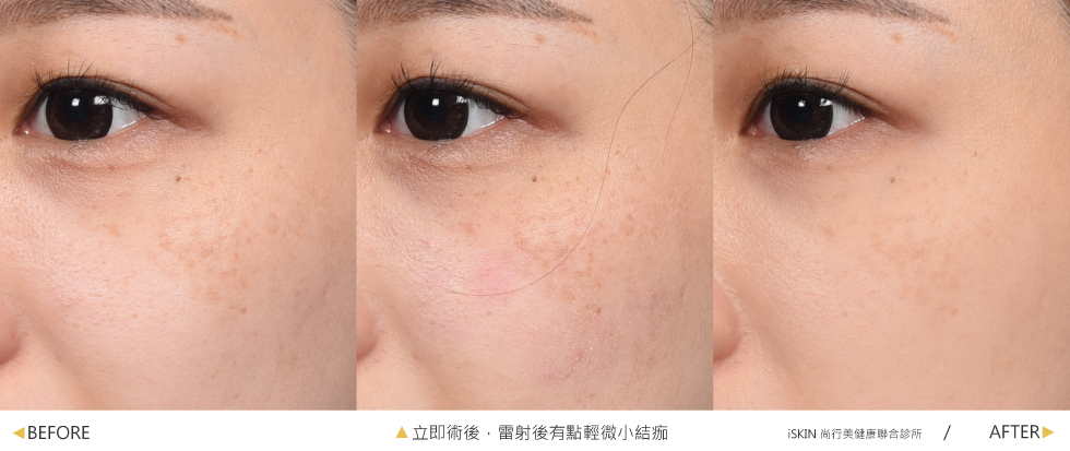 TWO TW0利用532nm/1064nm的探頭做治療,不過因為深層斑的部份很頑固,因此以下先給大家看看一次的治療效果