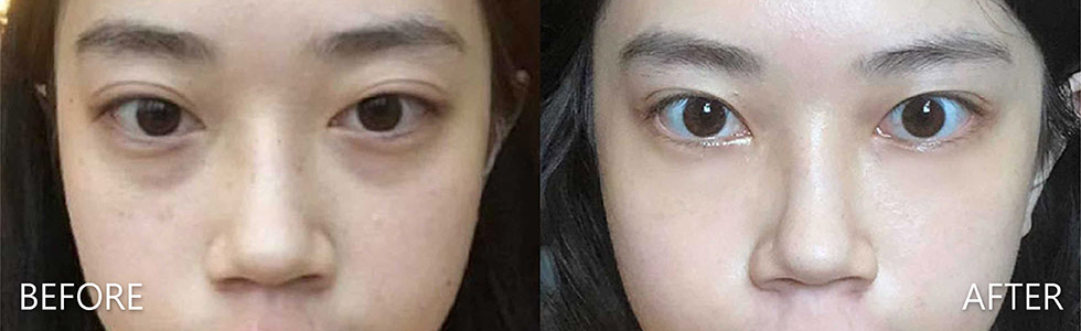 術前素顏(左圖),眼袋好明顯!!!術後淡妝(右圖)就可以還我好氣色~