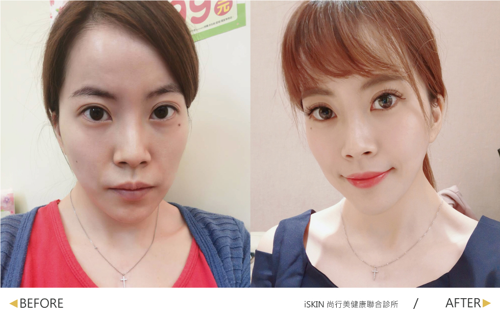 玻尿酸撫平法令紋、填補蘋果肌增加臉部輪廓的柔和感,施打在太陽穴凹陷處幫助偷偷增加好人緣。