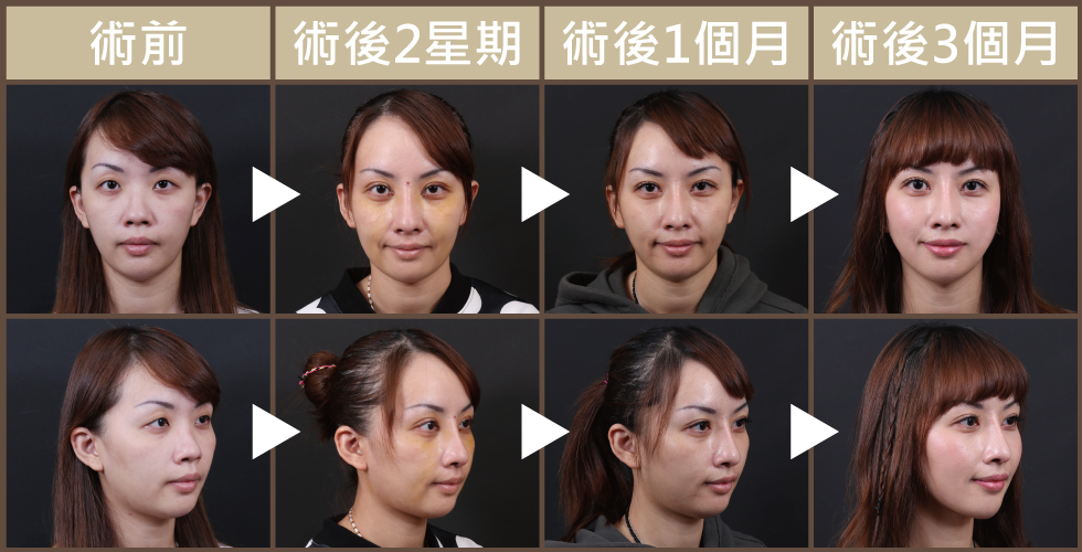 整外手術是「不求快,只求好」,每一次的我都更進步;順便一提,額頭中間紅點是為了幫助人工鼻模術後定位用的小傷口,約一個月左右就消失囉。